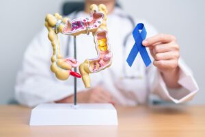 intestino e nastro del cancro
